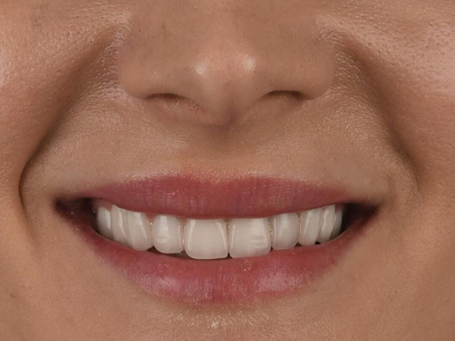 Hollywood Smile & E-Max Lamine Veneer - SONRA