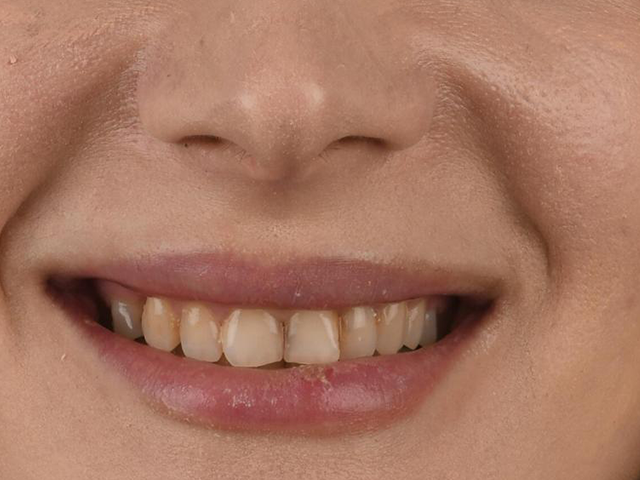 Hollywood Smile & E-Max Lamine Veneer - ÖNCE