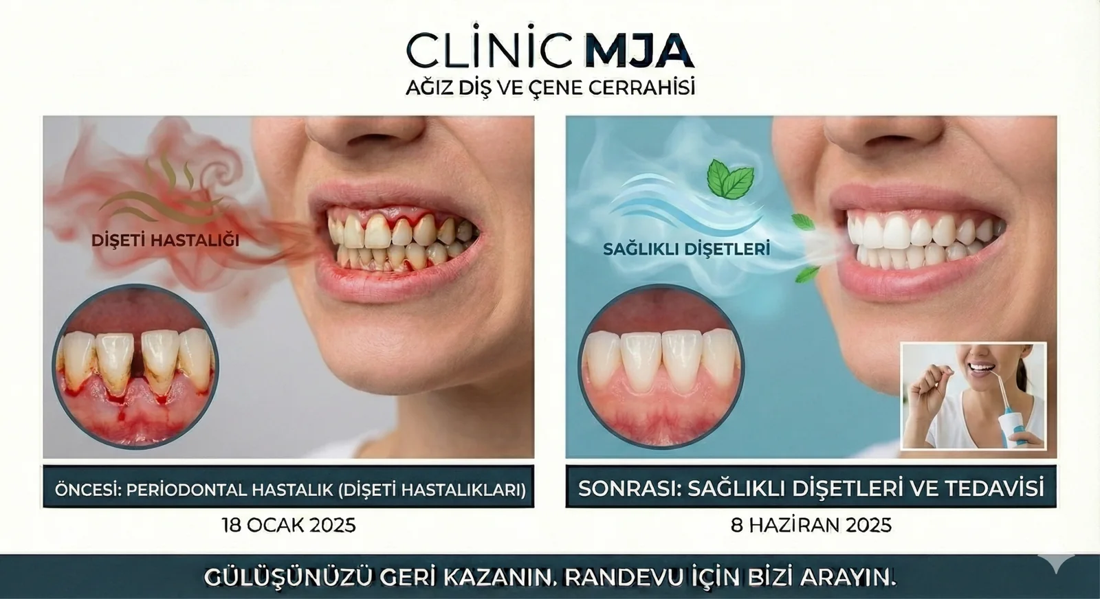 Periodontoloji (Dişeti Hastalıkları)