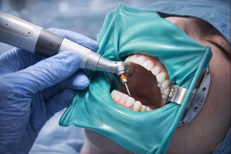 Endodonti (Kanal Tedavileri)
